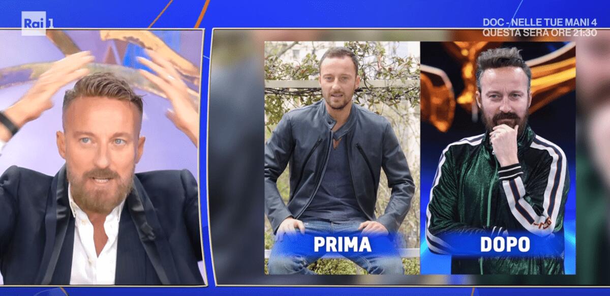 Francesco Facchinetti, la battaglia contro la calvizie: "Ho trovato la pace con una patch cutanea" - 