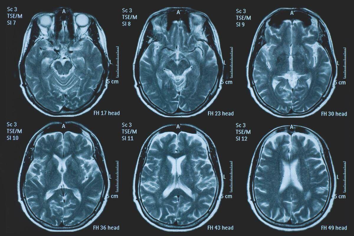Una persona su 3 ha un disturbo neurologico, a Napoli arriva BrainSpace House - 